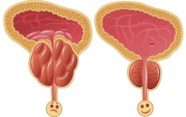 How Prostalix works for prostatitis before and after treatment