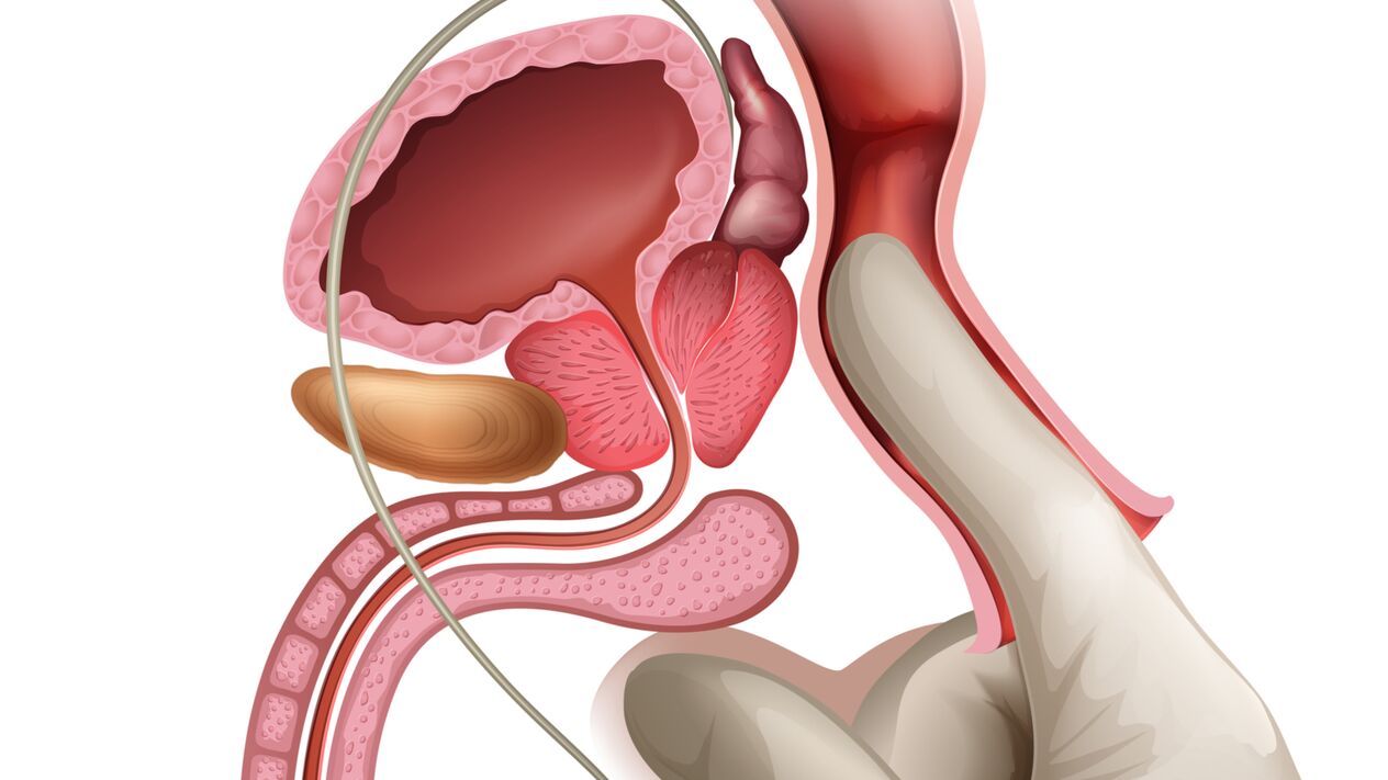 Prostate massage is an effective method for treating congestive prostatitis