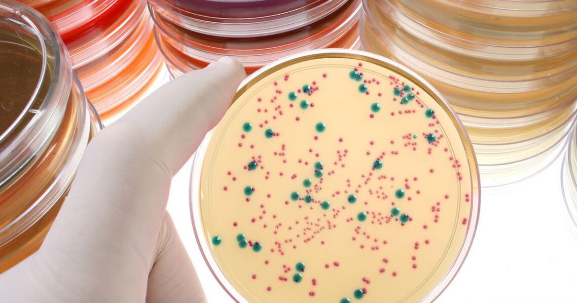 Bacterial chronic prostatitis is detected by analyzing urine and prostate secretions