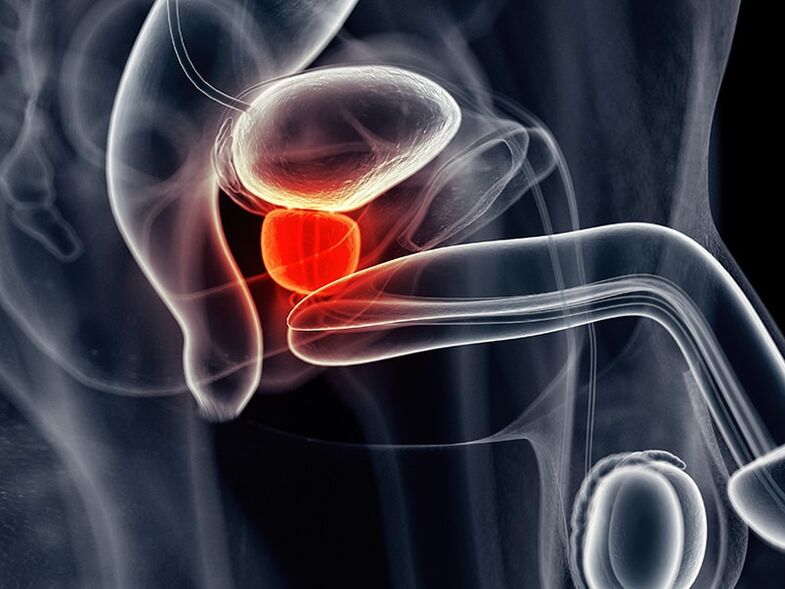 Inflammation of the prostate as a side effect of chronic prostatitis